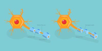 3D Isometric Flat Conceptual Illustration of Multiple Sclerosis, Demyelinating Disease vector