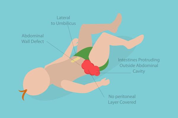 3D Isometric Flat Conceptual Illustration of Gastroschisis, Abdominal Pain Belly Button