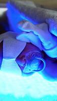 Tiny newborn in diaper and socks on hands lies on the UV lamp. Infant with pacifier and bandage on eyes is getting treatment from neonatal jaundice. Close up. Vertical video