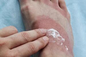 Foot with sunburn and cream application. Person applying cream to sunburned foot. Sunburned feet with topical ointment. Human foot with reddened skin and cream. Treatment of sunburn on foot with cream photo