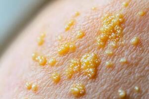 Closeup view of skin lesions exhibiting clustered papules photo