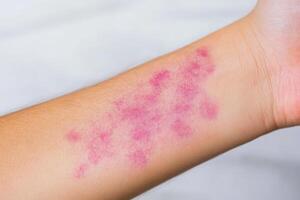 Childrens arm showing allergic reaction rash photo