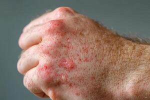A man with red spots on his hand photo