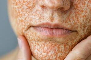 A woman with a lot of freckles on her face photo