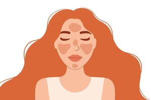 Woman with Rosacea illustration. The image highlights skin conditions such as rosacea, with visible red patches on the forehead, cheeks, and chin vector