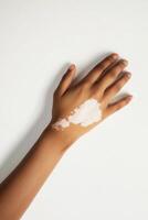 Exploring beauty and diversity through a hand displaying patterns of vitiligo on a minimalist white background photo