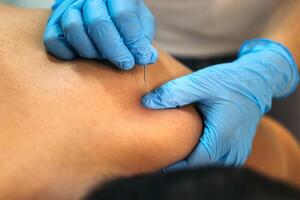 Physiotherapy Clinic Dry Needling process photo