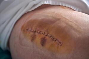 Leg of unrecognizable patient with stitches photo