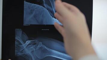 Doctor Analyzing X-Ray of Shoulder Joint video