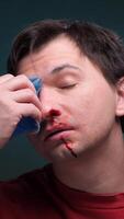 vertical Man using ice pack for nosebleed and bruising injury video