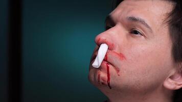 Man suffering from nosebleed holding tissue against nostrils. nosebleed stopped with a tampon video