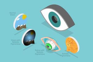 3D Isometric Flat Conceptual Illustration of Retinal Degenerative Vision , Age-Related Macular Degeneration vector