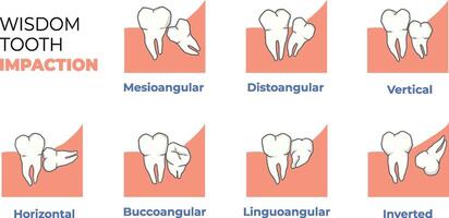 illustration of wisdom tooth impaction classifications vector