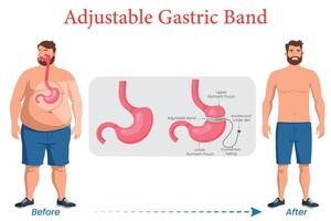 Adjustable Gastric Band Before and After Transformation vector