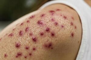 Close-up of a Person's Shoulder Covered in Small Red Bumps photo
