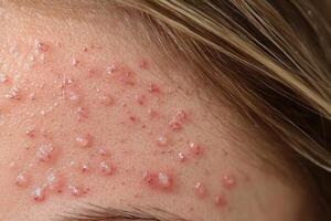 Close-up of a person's forehead with multiple red bumps photo