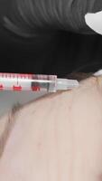 This image closely examines a botulinum injection for reducing facial wrinkles, highlighting the careful syringe technique used for effective cosmetic enhancement and skin rejuvenation video