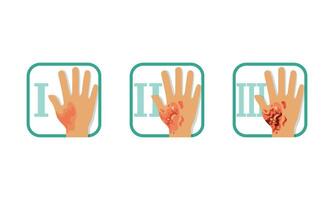 Degree of Skin Burns Set, Normal to Serious Injury, First, Second and Third Degree, Brochure or Poster Infographic Element Illustration vector