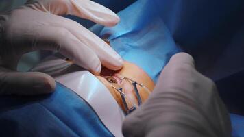 Laser vision correction. A patient and team of surgeons in the operating room during ophthalmic surgery. Eyelid speculum. Lasik treatment. Patient under sterile cover 51 video