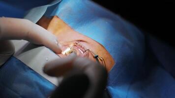 Laser vision correction. A patient and team of surgeons in the operating room during ophthalmic surgery. Eyelid speculum. Lasik treatment. Patient under sterile cover 50 video