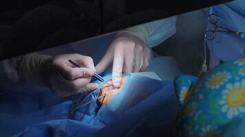 Laser vision correction. A patient and team of surgeons in the operating room during ophthalmic surgery. Eyelid speculum. Lasik treatment. Patient under sterile cover 61 video