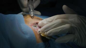 Laser vision correction. A patient and team of surgeons in the operating room during ophthalmic surgery. Eyelid speculum. Lasik treatment. Patient under sterile cover 12 video