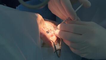 Cataract surgery close up. Surgeon operating eye cataract in hospital surgery 6 video