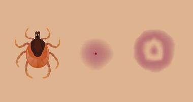 Tick biting skin causing Lyme disease and erythema migrans rash vector