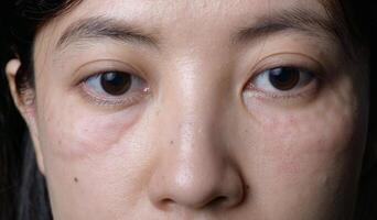 Swollen under eye area with visible puffiness and redness, possibly post treatment or due to irritation photo