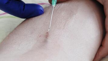 Close-up of a needle approaching a vein on the arm, guided by gloved hands during medical injection, emphasizing precision and sterile healthcare practice video