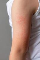 Child's arm with red rash photo