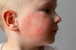 Small child with red rash on cheek photo