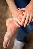 eczema dermatitis on hands and feet. red spots on the skin. dry skin photo