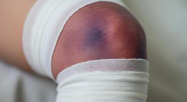 Knee Injury with Bandage and Bruise Close Up for Healthcare photo