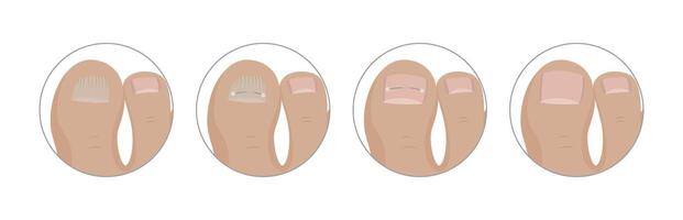 Correcting ingrown toenail with titanium thread, podiatrist performs step by step medical procedure aimed at alleviating pain and restoring healthy nail growth vector