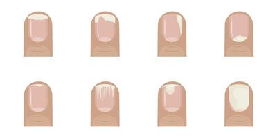 Onycholysis patterns are depicted, showing various stages and forms of nail separation from the nail bed, providing a visual guide for identifying nail disorders vector