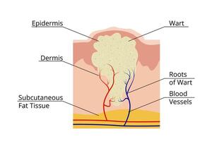 Medical illustration showing structure of common wart growing on skin with roots reaching subcutaneous fat tissue, affecting epidermis and dermis through blood vessels vector