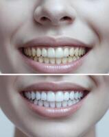Before and after photos of teeth whitening