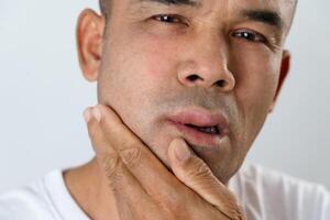 The man has facial swelling due to an allergic reaction to triggers such as insect bites stings.10 photo