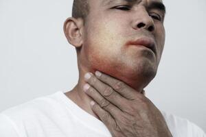 The man has facial swelling due to an allergic reaction to triggers such as insect bites stings.9 photo
