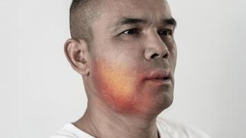 The man has facial swelling due to an allergic reaction to triggers such as insect bites stings.4 photo