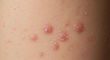 Close-up photograph revealing a person's skin condition, potentially psoriasis or eczema with raised, inflamed patches photo