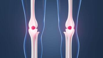 Human kneecap model, joint swelling, joint pain, Biological and medical concepts, 3d rendering. video