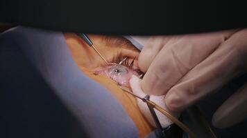 Surgeon using clamp and micro instruments during laser eye correction. video