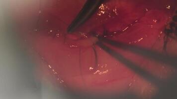 Surgery to correct strabismus. View through a microscope. The surgeon sews up the eye. Cphthalmic surgery video