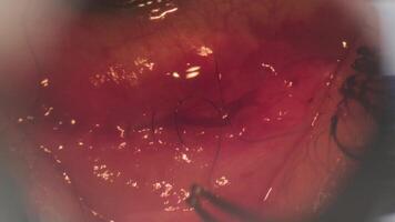 Surgery to correct strabismus. View through a microscope. The surgeon sews up the eye. Cphthalmic surgery 2 video