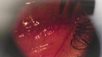 Surgery to correct strabismus. View through a microscope. The surgeon sews up the eye. Cphthalmic surgery 3 video