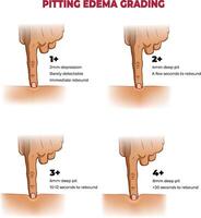 illustration of pitting edema grading infographic vector
