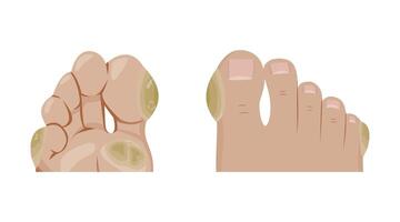 Calluses forming on pressure points of feet, sole and top views. Thick, hard skin develops from friction, discomfort and pain vector