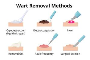 Different methods for removing warts including cryodestruction, electrocoagulation, laser treatment, removal gel, radiofrequency and surgical excision are depicted vector